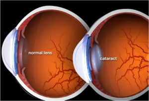 ofthalmologiki monada ioannina laserlens kataraktis