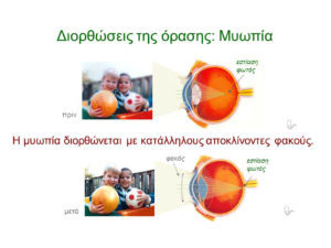 ofthalmologiki monada ioannina laserlens myopia