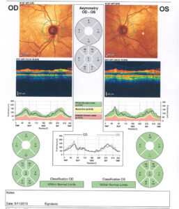 ofthalmologiki monada ioannina laserlens oct thilis optikou nevrou